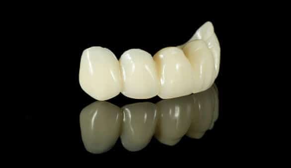 Keramik für Zahnimplantate